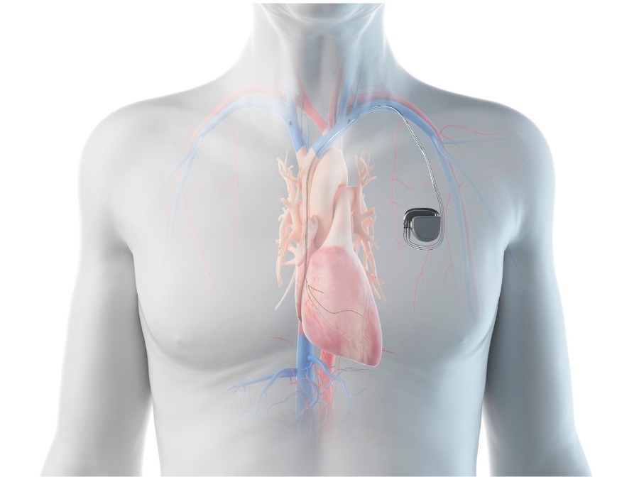 Maintenance Clinics 1 Image of a man which shows the heart and arteries as well as a pacemaker implanted on the chest. Stockton Cardiology has a Pacemaker Clinic.